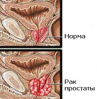 psa test za prostata)