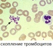 Сдать анализ тромбоцитов, анализ крови на тромбоциты, подсчет тромбоцитов по Фонио, тромбоциты по Фонио