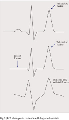 hyperkalemia4.jpg