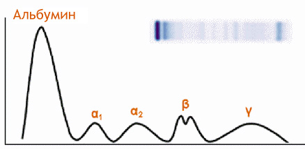 protein-electrophoresis-graph-en.jpg
